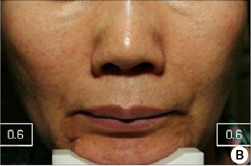 clinical trial B after four weeks image