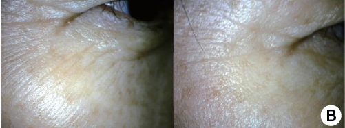 clinical trial C before and after image