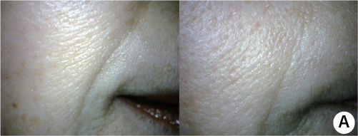 clinical trial D before and after image