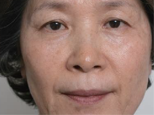 clinical trial E after image