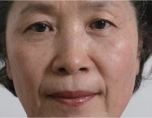 clinical trial E before image