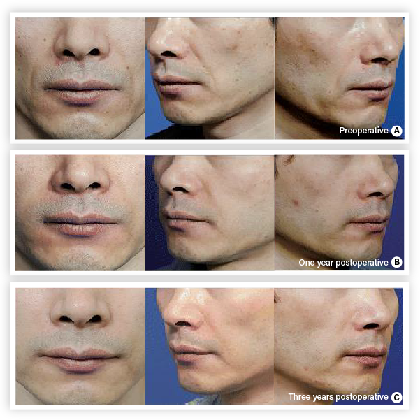 clinical trial F before and after image