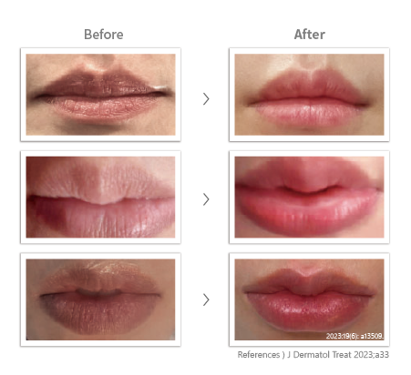 purilips before and after image by J Dermatol Treat 2023;a33 References